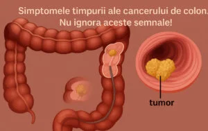 Boala care ucide mii de români! Simptomul banal pe care îl ignori, dar anunță cancerul de colon